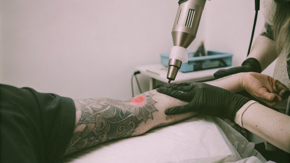 tattoo removal