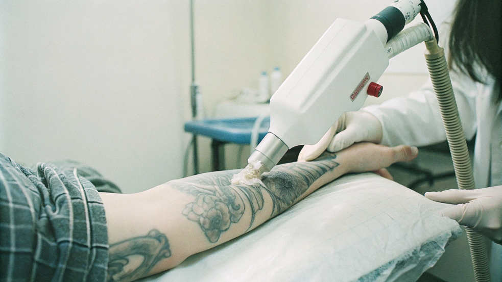 tattoo removal